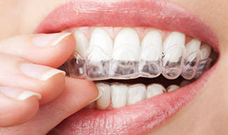 Invisalign