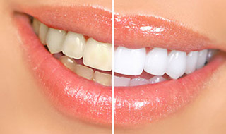 Whitening