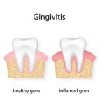 Gingivitis Inflamed Gum Comparison