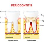 Periodontitis image