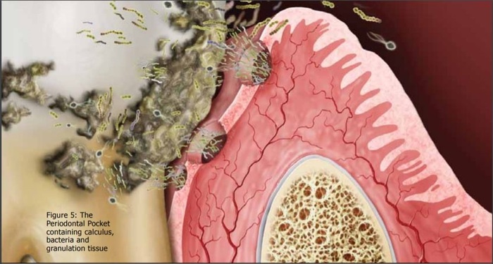 Periodontal Figure5